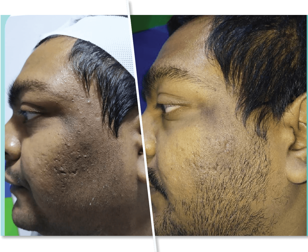 Men Before and After Dark Spots Removal